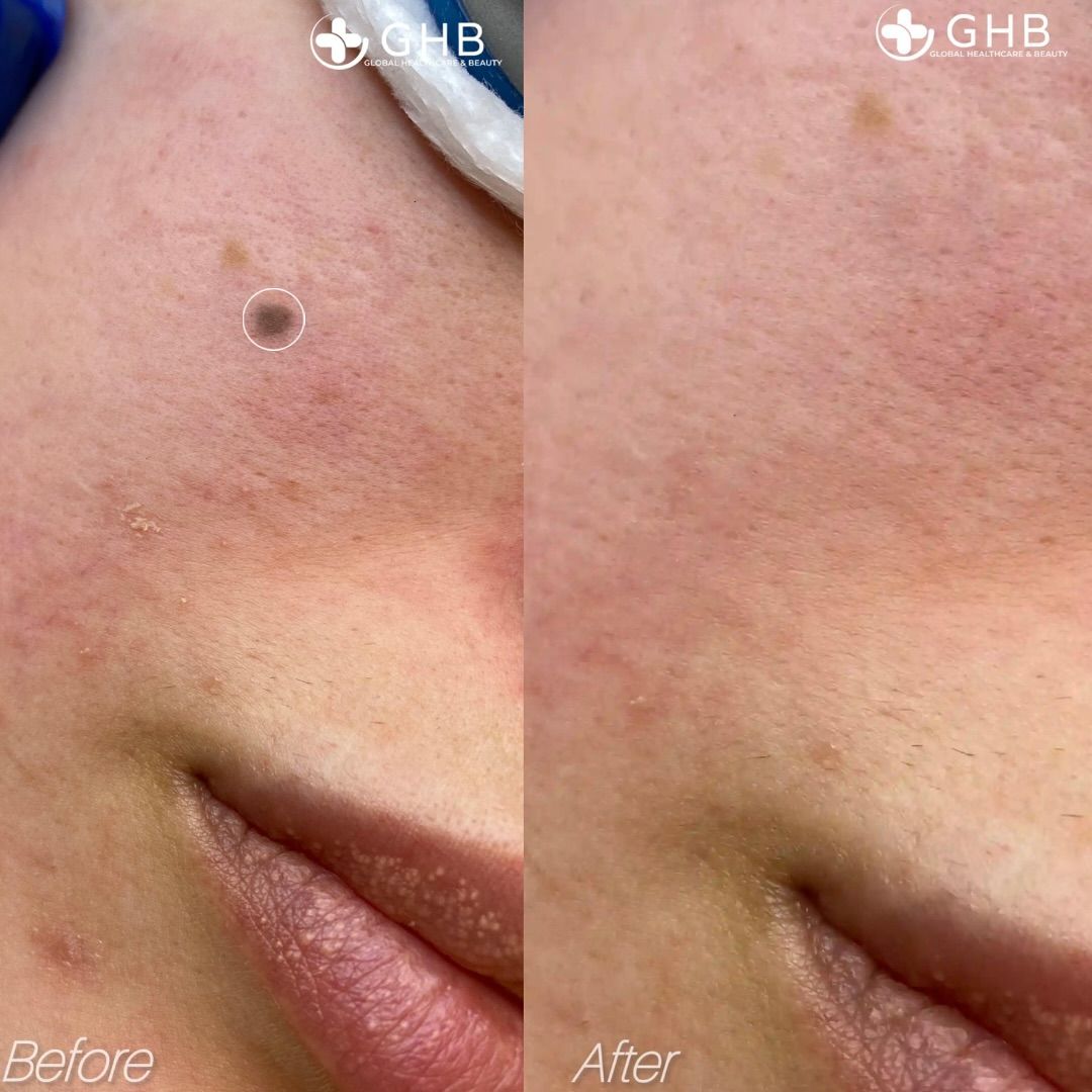 Mole Extension